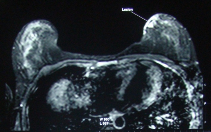 Figure 1: Figure 1: MRI of the breast showing the lesion