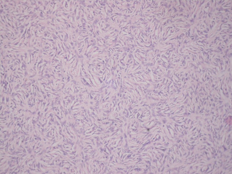 Figure 2: Photomicrograph showing dermatofibrosarcoma (H & E x 40)