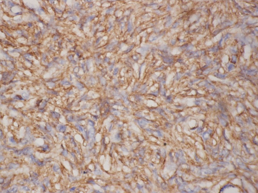 Figure 3: Photomicrograph showing immuno-histiochemistry for CD 34