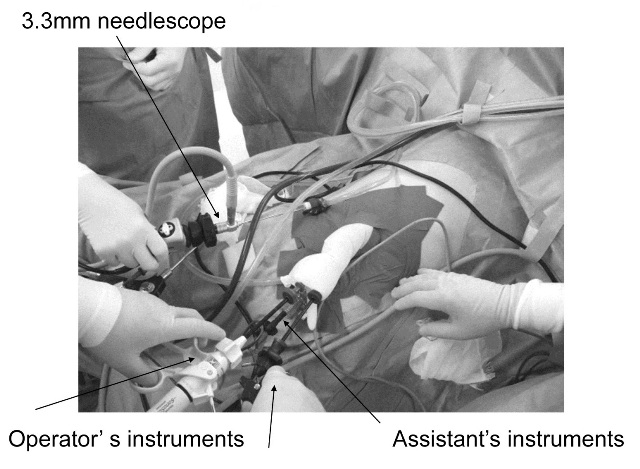 Figure 1: Outside operative view of single-incision needlescopic cholecystectomy.