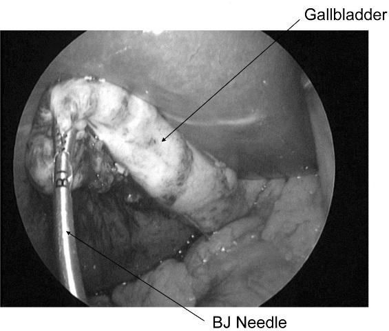Figure 2: The infundibulum of the gallbladder was grasped with BJ needle.