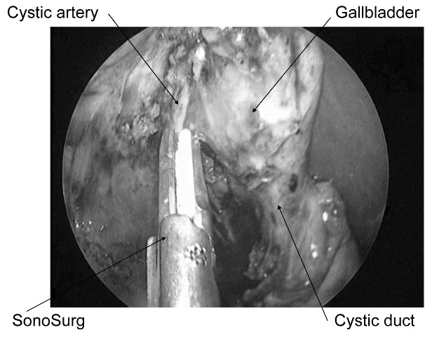 Figure 3: The cystic artery was divided and identified.