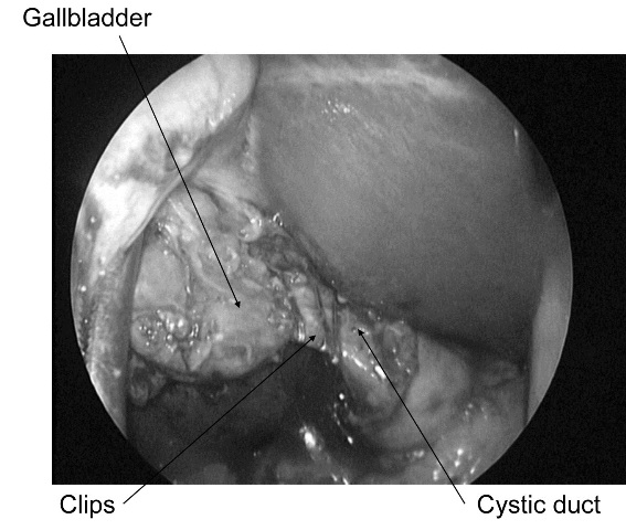 Figure 4: The cystic duct was ligated with clips.