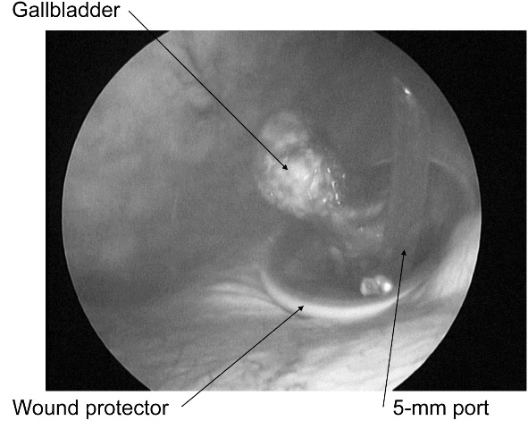 Figure 5: The needlescope visualize retrieval of the resected gallbladder through the umbilical wound.