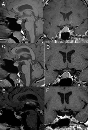 Fig 1 A-B: T1-weighted sagittal and coronal sellar MRI revealed a right-side sellar lesion, compressing the pituitary gland and displacing the pituitary stalk; C-D: 1 year post-medical therapy T1-weighted sagittal and coronal images MRI Revealed the persistence of the lesion without any relevant modifications; E-F: Three month T1-weighted post-operative MRI showing the removal of the xantogranuloma with preservation of the pituitary gland.