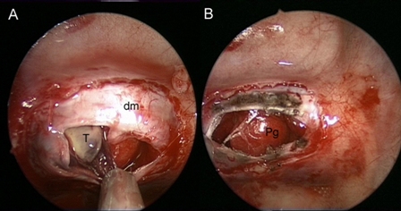 Fig. 2A: Intraoperative images showing a grey-brownish soft lesion located in the right portion of the sella and the normal pituitary gland, on the left side; B: after the tumor removal, the residual pituitary gland appears preserved and decompressed. Dm: dura mater; Pg: pituitary gland; T: tumor.