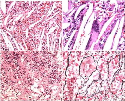 Fig. 3A: Cholesterol clefts, hemorrhagic extravasation and dense inflammatory infiltrate (H/E 20x); B: note multinucleated giant cell (H/E 40x); C: perilesional localization of acini and nests of adenohypophysial cells. Some cells are acidophilic or basophilic, others are cromophobic (H/E 20x); D: reticulin fiber network retains normal acinar architecture (reticulin staining 40x).