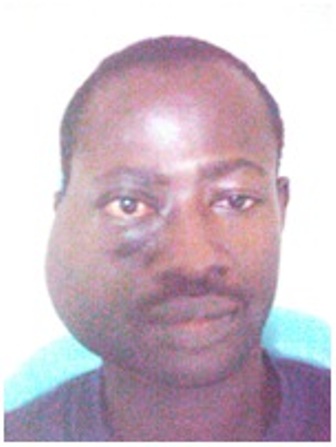 Figure 1: showing clinical appearance at Presentation at OMFS clinic, LASUTH
