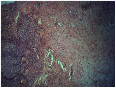 Figure 3: Photomicrograph from light microscope showing myxoid background with infiltrates of macrophages and plasma cells. H & E x 100