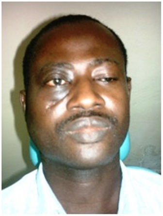 Figure 4: Clinical photograph 2weeks post steroid therapy