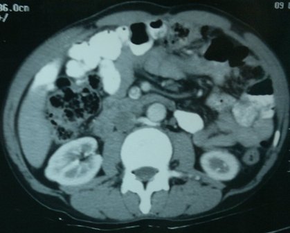 Figure 1: Computerized tomorgraphic scan showing bilateral adrenal metastasis