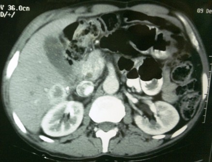 Figure 2: CT scan showing adrenal metastasis with liver metastasis