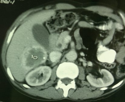 Figure 3: CT scan showing progression of disease