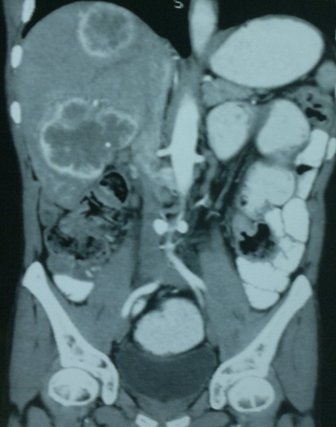 Figure 4: Saggital section showing multiple liver metastasis
