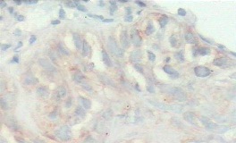 Matrix Metallopeptidase 9 (MMP-9) Expression in Oral Cancer Andand ...