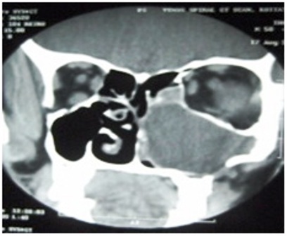 Fig.1 CT scan shows soft tissue density lesion with well defined margins in left maxilla with extension into nasal cavity