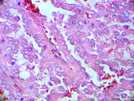 Figure2: Histology of the right lobe of the thyroid demonstrating Papillary Microcarcinoma