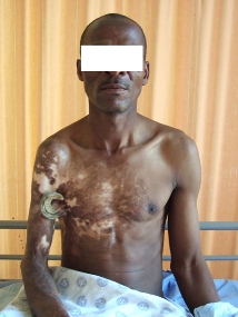 giant cutaneous horn arising from a burn scar a case report and literature review world journal of medical and surgical case reports