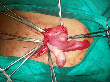 Figure 1- Atrophied uterus as the content of the hernia sac.