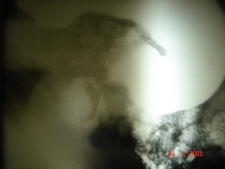 Figure 1. Barium meal showing filling defect.