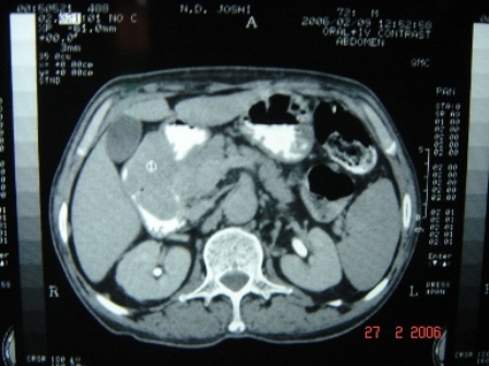 Figure 2. CT scan showing heterogenous soft mass.