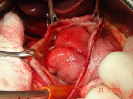 Figure 3. Leiomyoma exposed during surgery.