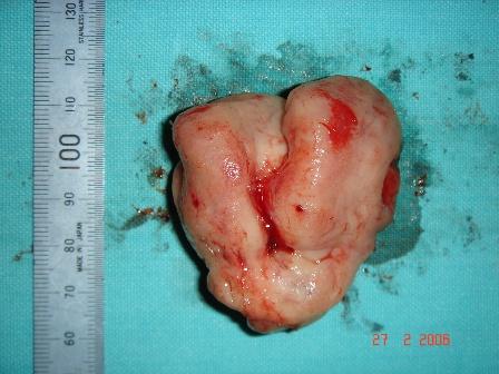 Figure 4. Resected leiomyoma.