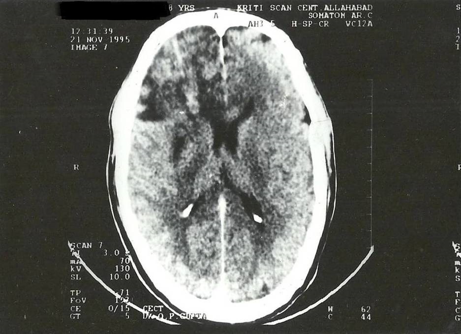 Fig.1: CT Axial Section showing frontal lesion