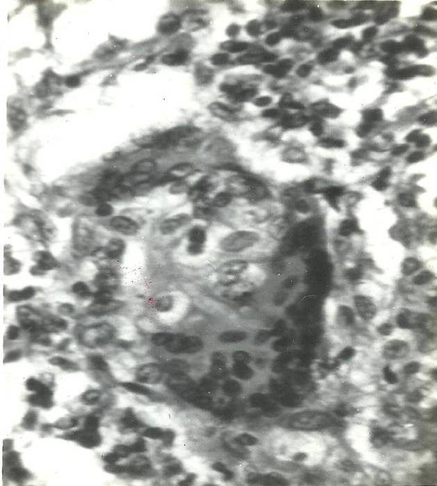 Fig.2: Microhistolopathology of excised lesion
