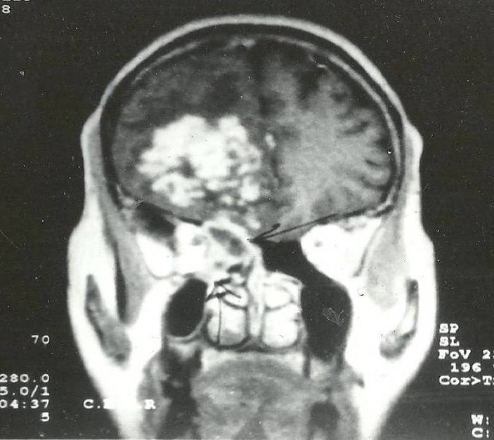 Fig.3: Coronal view of Contrast MRI exhibiting lesion in frontal lobe involving ethmoid sinus