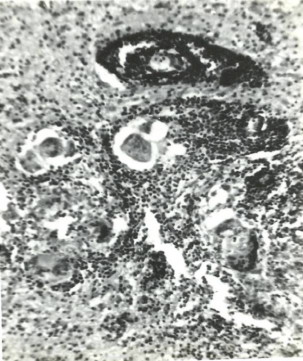 Fig.4: Micro-histopathological photograph of excised lesion