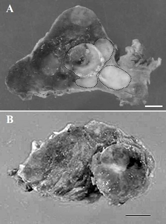 Figure 1: (A) Cut surface of specimen showing a solid follicular carcinoma (left, surrounded by dotted line) and an adjoining homogenous white papillary carcinoma (right, surrounded by dotted line). Bar = 0.5 cm. (B) Cut surface of specimen showing adenomatous goiter (surrounded by dotted line). Bar = 0.5 cm.
