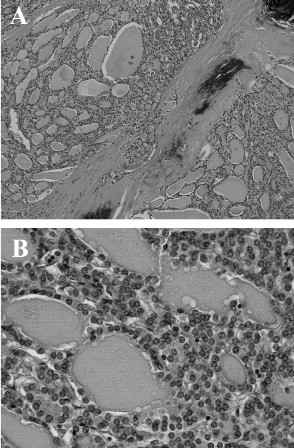 Figure 2: (A) Low-power view of follicular carcinoma showing the follicular structure (hematoxylin-eosin; original magnification, ×100). (B) High-power view of follicular carcinoma (hematoxylin-eosin; original magnification, ×400).