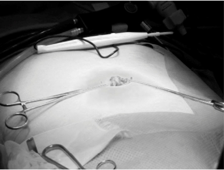 Figure 1: A 2.5-cm vertically oriented incision was made through the center of the umbilicus. 