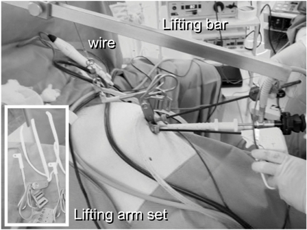 Figure 2: The operating field was created using the original bar abdominal wall-lift method with a rigid bar. 