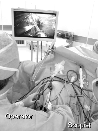 Figure 3: This procedure was performed by one surgeon standing between the legs of the patients and one laparoscopist on the left side.