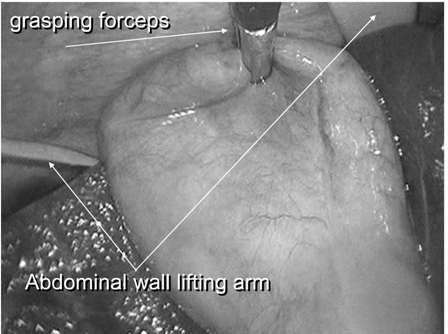 Figure 4: One grasper was used at the fundus of the gallbladder for retraction laterally or upward.