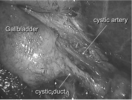 Figure 5: The cystic duct and artery were divided and identified to obtain the critical view.