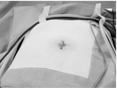 Figure 6: The closed umbilical wound.