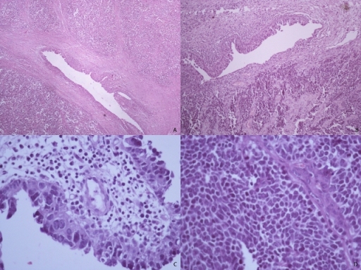Figure 1: Small cell carcinoma of the renal pelvis. (A&B) low power view shows renal pelvis epithelium with proliferation of small round cells (H&E, 40X). (C) Transitional cell carcinoma in situ of the renal pelvis (H&E, 40X). (D) High power view of the small cell carcinoma area (H&E, 40X).