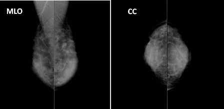 Figure 1. Findings of mammography. Heterogeneous with a high density. A lobulated, well- and smoothly-defined, and isoconcentrated tumor was observed in the left breast.