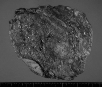 Figure 2. Excised specimen and pathological examination. Solid-tubular carcinoma, g, ly0, v0, n(0/10), nuclear grade 3 (score 5), nuclear atypia 3, mitotic counts 3, and ER / PR / HER2=0% / 0% / 1+.