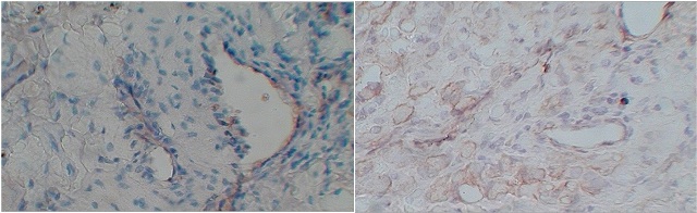 Figure 1: A. Photomicrograph showing negative staining H&E X100 B). Cytoplasmic 1+ expression of VEGF in SCC grade 1.