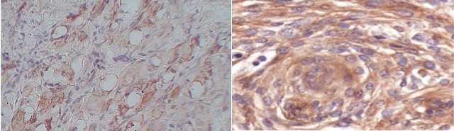 Figure 2: Moderate (2+) cytoplasmic cepression of VEGF in grade II SCC H&E X 100 B). Strong cytoplasmic expression of VEGF in grade III SCC. H & E X400.
