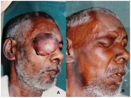 Figure 1: (a) A pre-treatment photograph of patient of squamous cell carcinoma right upper eyelid; (b) A post treatment photograph of same patient. Note the marked reduction in size of the tumor and complete disappearance of pre-auricular lymph node.