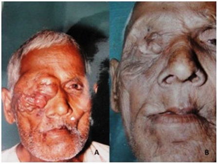 Figure 2: (a) Clinical photograph of patient showing recurrence (after surgery) of squamous cell carcinoma of right upper eyelid; (b) A post treatment clinical photograph of same patient. Note the marked reduction in size of the tumor