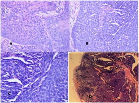 Figure 4 Photomicrograph of (a) Well differentiated squamous cell carcinoma grade I (Hematoxylin and Eosin, X100) (b) Moderately differentiated squamous cell carcinoma grade II (Hematoxylin and Eosin, X125) (c) Poorly differentiated squamous cell carcinoma (Hematoxylin and Eosin, X100) (d) Moderately differentiated sebaceous gland carcinoma grade II, Showing lobules of malignant cells with sebaceous differentiation (Hematoxylin and Eosin, X100)