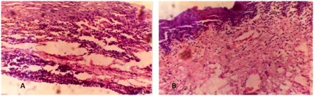 Figure 5: (a) Photomicrograph of post chemotherapy biopsy showing dense lymphatic infiltration. There is a slight thickening of epithelium with spongiosis; (b) Photomicrograph of post chemotherapy biopsy showing cleavage in epithelium with mostly round cell infiltration and fibrovascular proliferation in deeper layer. Total clearing of cancer cells. 