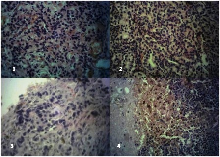 Figure 1: Lung (H & E x400) showing sheets of tumor cells having basophilic and pleomorphic nuclei with many mitotic figures; 2). Chest wall nodule (H&E x400) showing nests, ribbon and festoon of tumor cells with fairly regular nuclei and eosinophilic cytoplasm, up to 5 mitotic figures are seen in this field. 3). Dura mass (H&E x400) showing infiltrating tumor cells in cords with moderately pleomorphic nuclei. 4). Cerebral tissue (H&E x400) showing sheets of tumor cells with basophilic fairly regular nuclei, areas of hemorrhage and haemosiderin pigments are seen