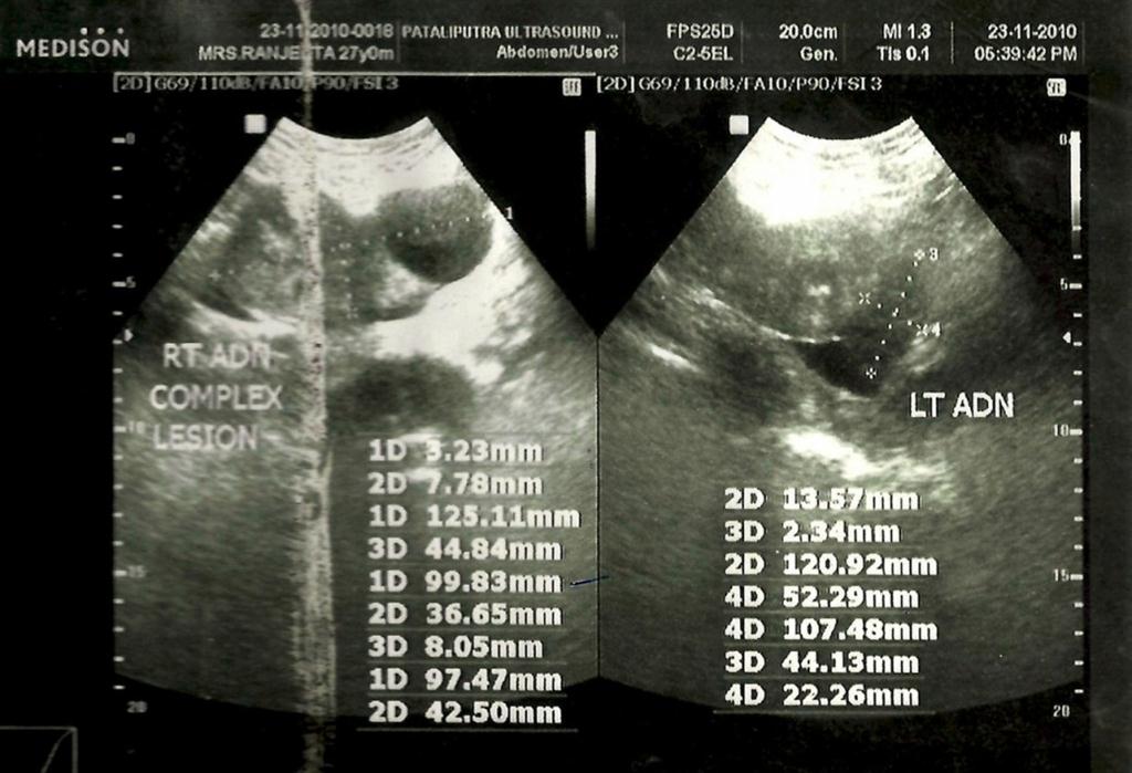 Figure 1: USG showing complex mass in right adnexa